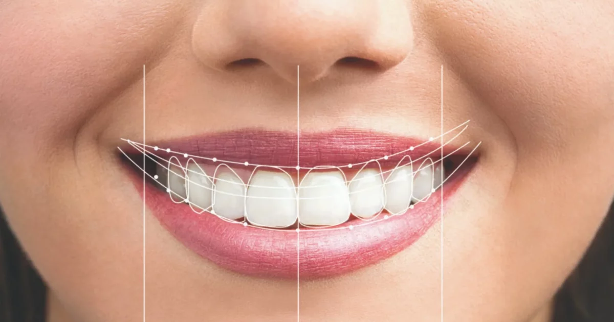 Estetik Diş Hekimliği (Hollywood Smile)